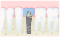 インプラント